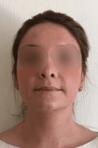 Nose After Reduction