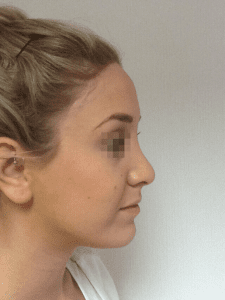 uppal-rhinoplasty-35-225x300